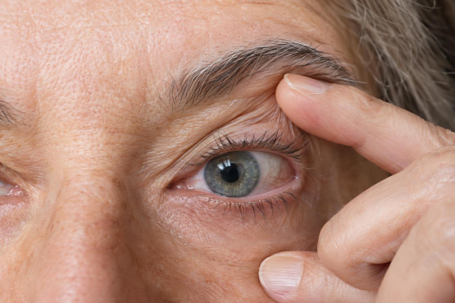 Se hai più di 60 anni probabilmente hai degli acari nelle palpebre: quando diventano pericolosi?