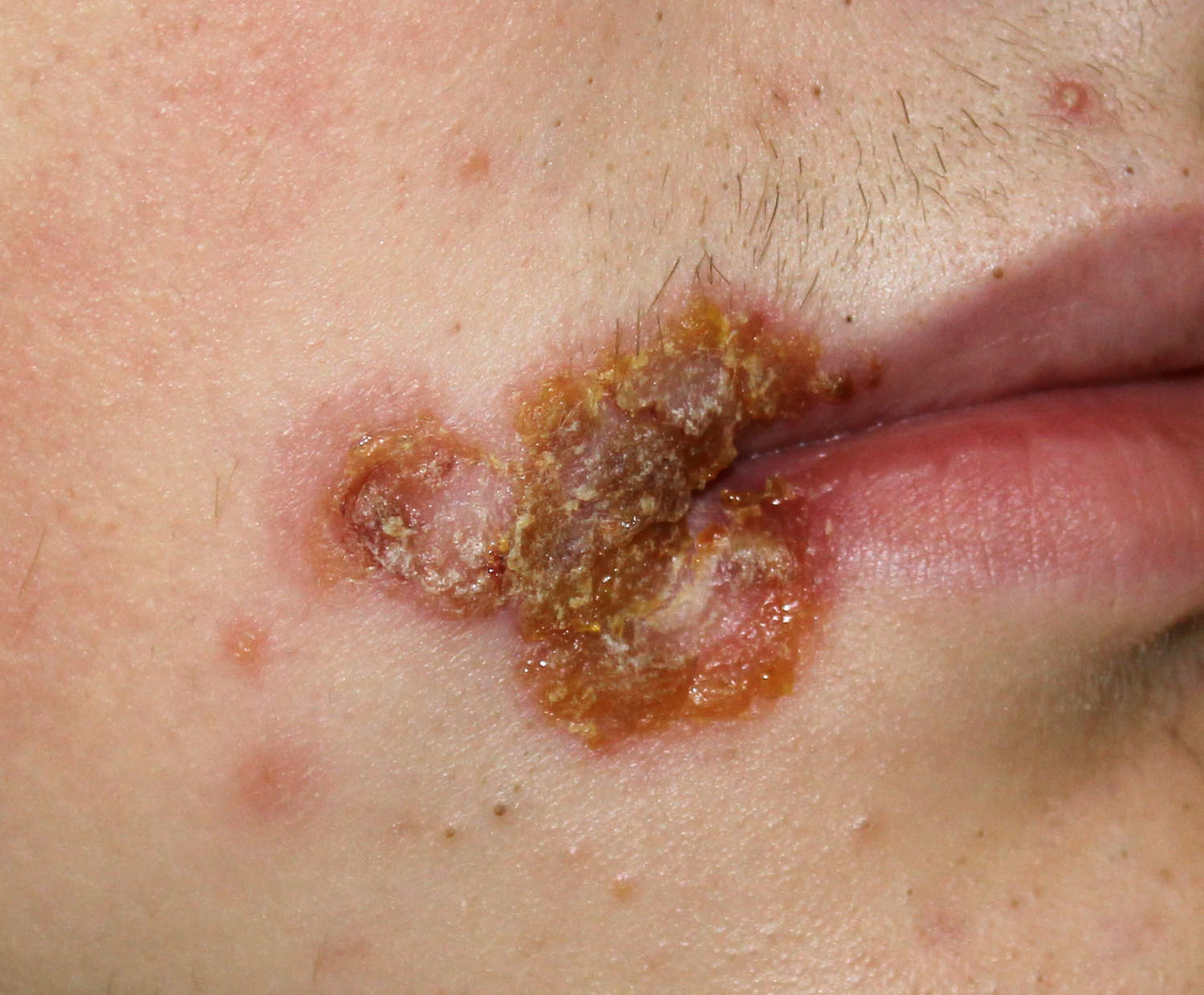 Impetigine sul labbro