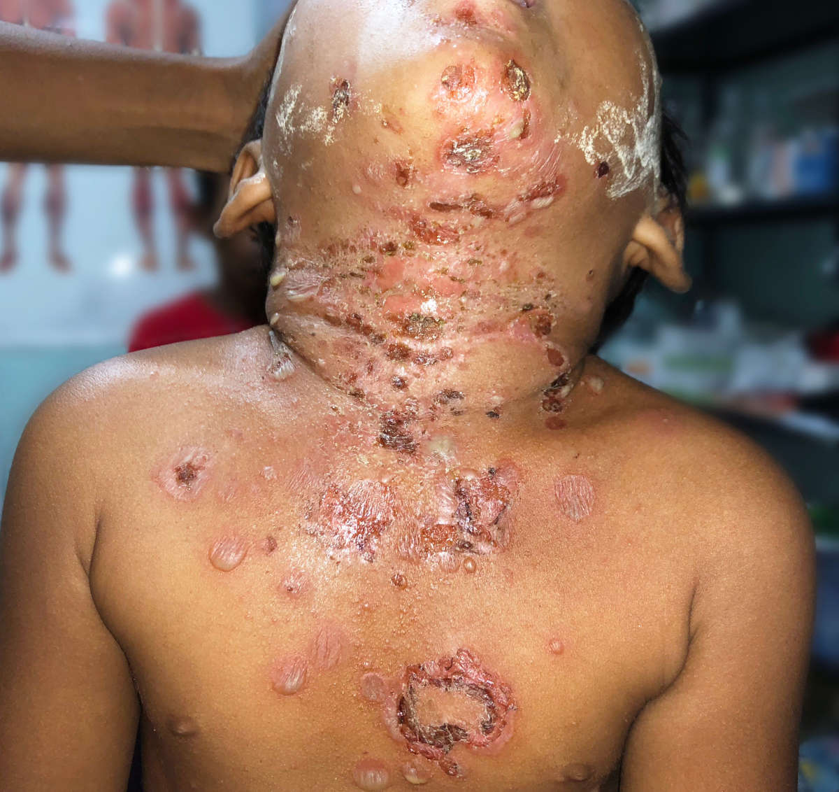 Grave forma di impetigine bollosa