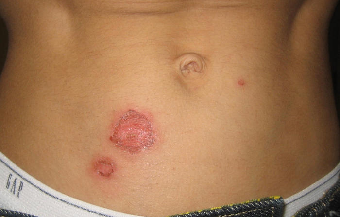 Fotografia di impetigine bollosa dopo l'apertura della bolla
