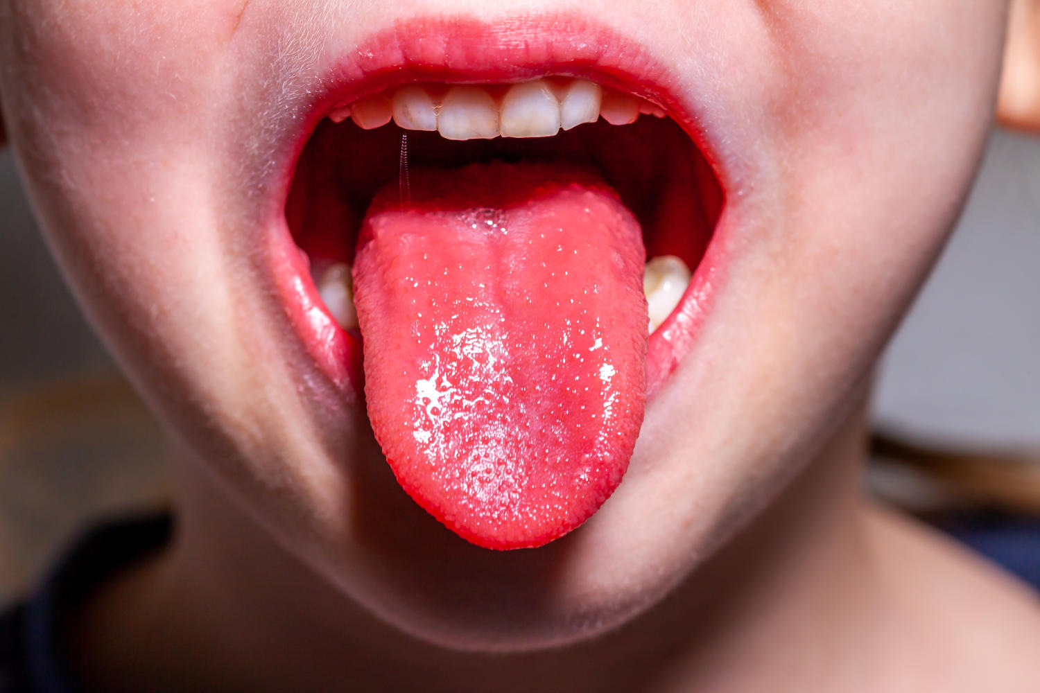 Lingua a fragola
