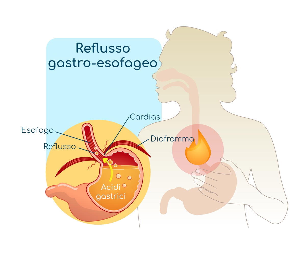 Anatomia semplificata degli organi coinvolti nel reflusso gastroesofageo