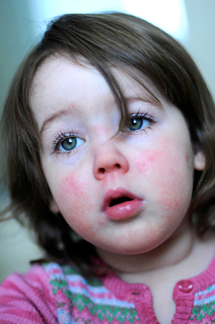 Immagine del viso di una bambina colpita da scarlattina, con la classica eruzione cutanea scarlatta