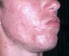 Acne, foto 2 https://en.wikipedia.org/wiki/Image:Acne_face.jpg