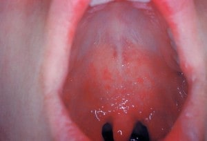 https://de.wikipedia.org/w/index.php?title=Bild:Measles_enanthema.jpg&filetimestamp=20070402211711