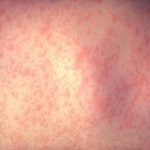Fonte: https://en.wikipedia.org/wiki/Image:Morbillivirus_measles_infection.jpg