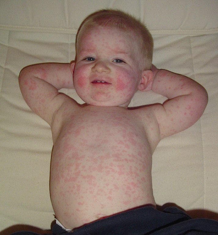 Fotografia di un bambino con la tipica eruzione cutanea della quinta malattia
