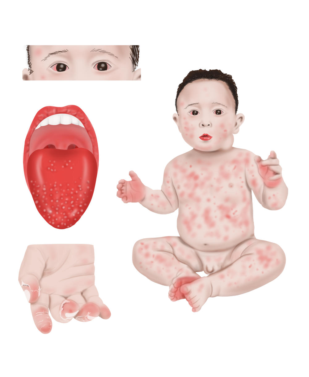 I sintomi della sindrome di Kawasaki