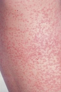 Rosolia Schiena con il caratteristico rash cutaneo tipico della rosolia