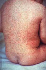 Bimbo con la rosolia Bimbo affetto da rosolia con il rash cutaneo particolarmente evidente