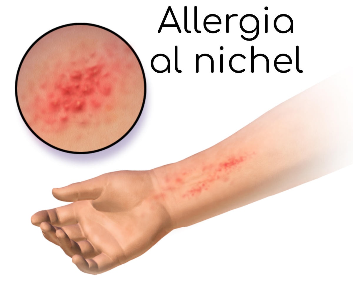 Esempio di reazione al nichel sul braccio di un soggetto allergico (ricostruzione grafica)