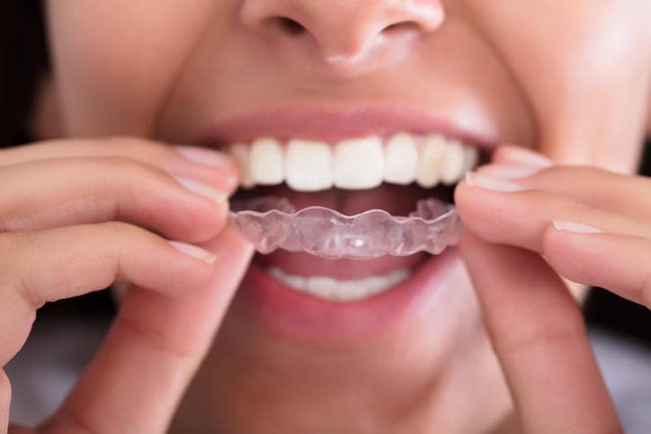 Donna nell'atto di indossare il bite per i denti