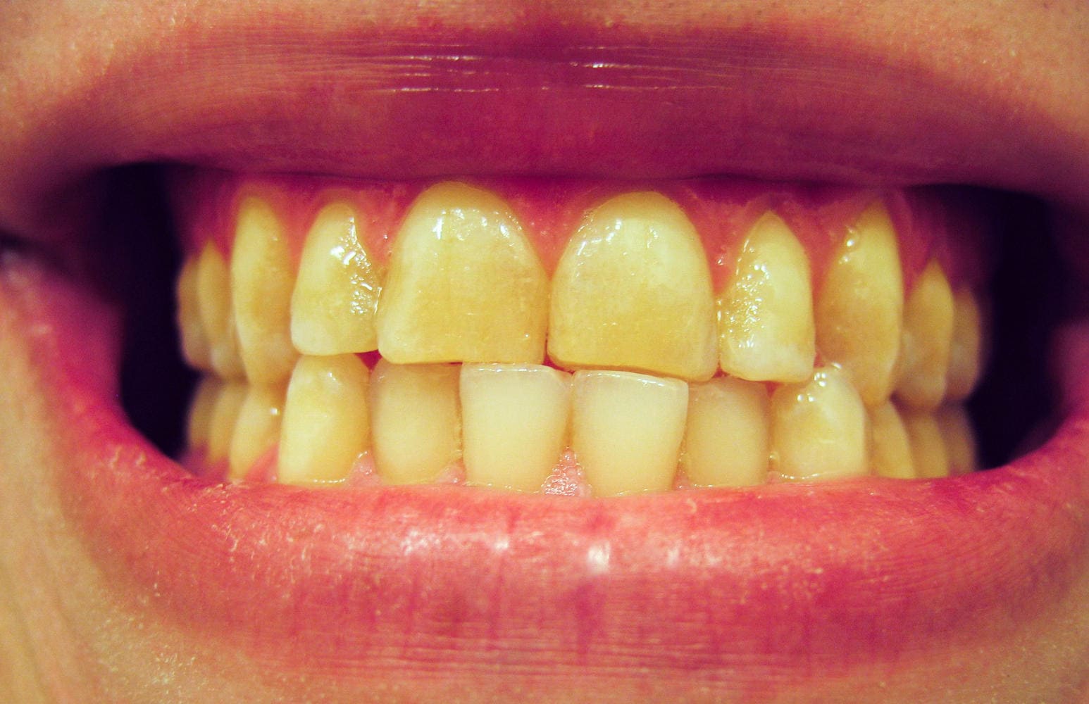 Primo piano di denti affetti da bruxismo e per questo piatti