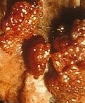 condilomi foto pene https://en.wikipedia.org/wiki/File:SOA-Condylomata-acuminata-man.jpg