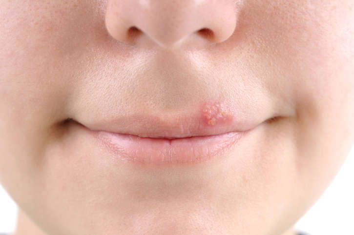 Primo di labbra con le tipiche bollicine causate dall'herpes labiale.