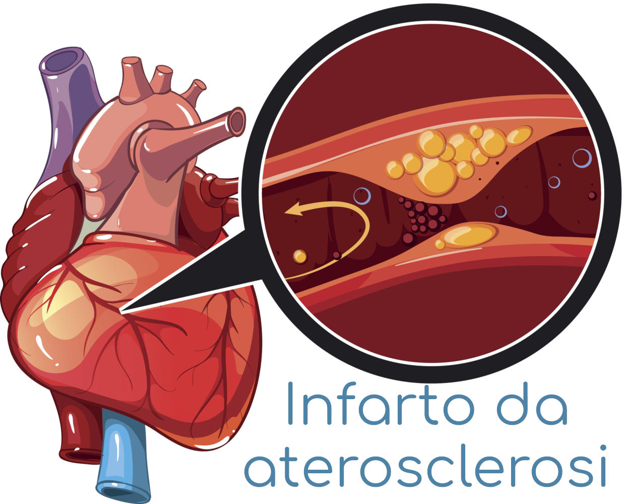 Semplificazione del meccanismo dell'infarto dovuto ad aterosclerosi