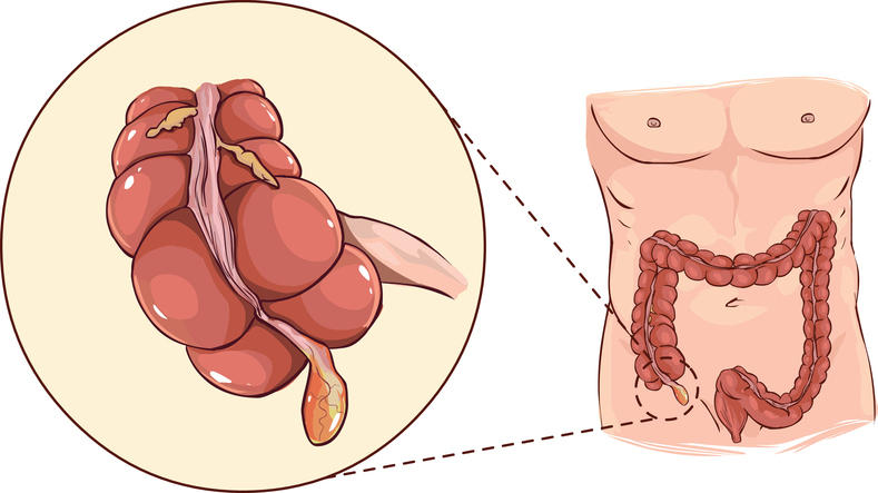 Ricostruzione grafica della posizione anatomica dell'appendice