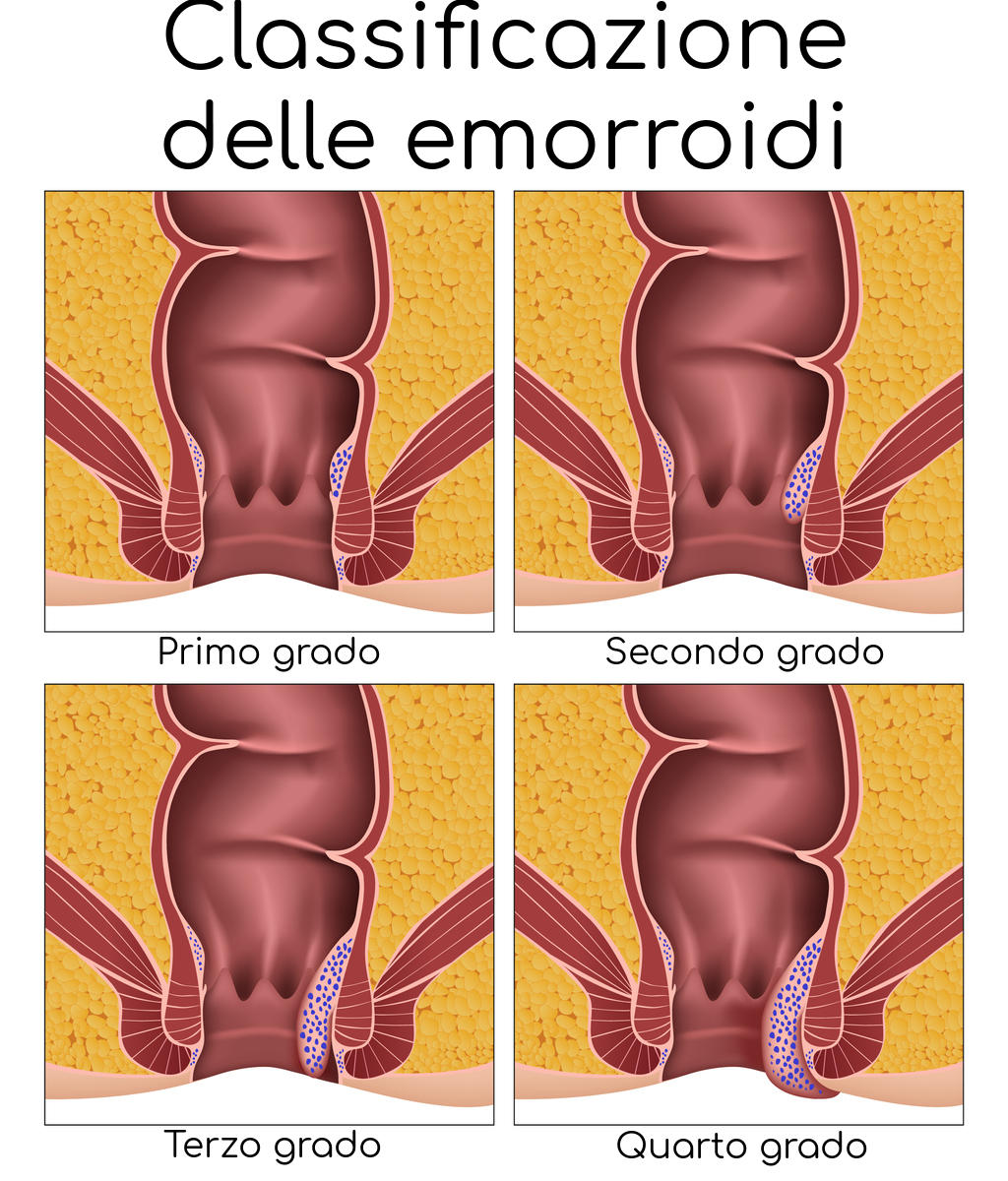 Rappresentazione grafica dei diversi gradi con cui vengono classificate le emorroidi