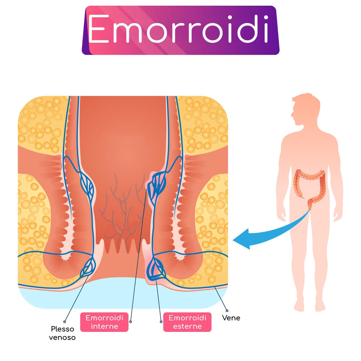 Anatomia semplificata delle emorroidi interne al canale anale ed esterne