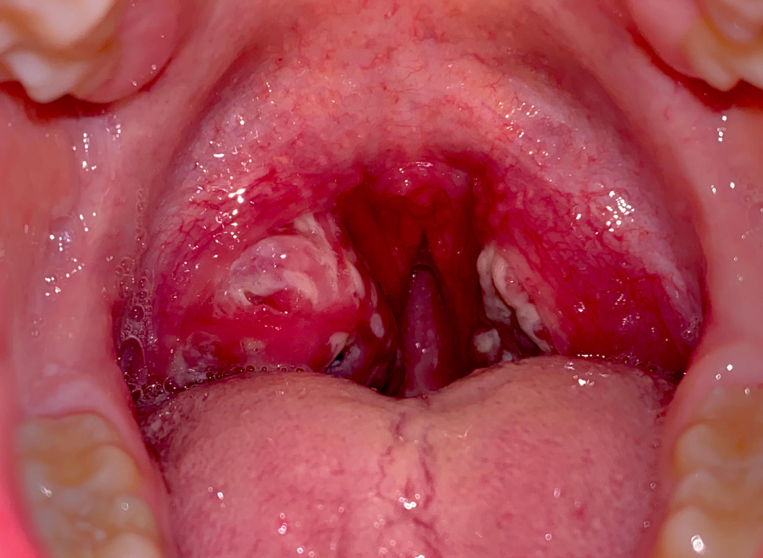 Primo piano di una gola con placche bianche causate da streptococco