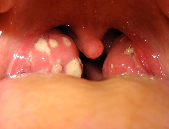 Fotografia che mostra il tipico mal di gola da streptococco