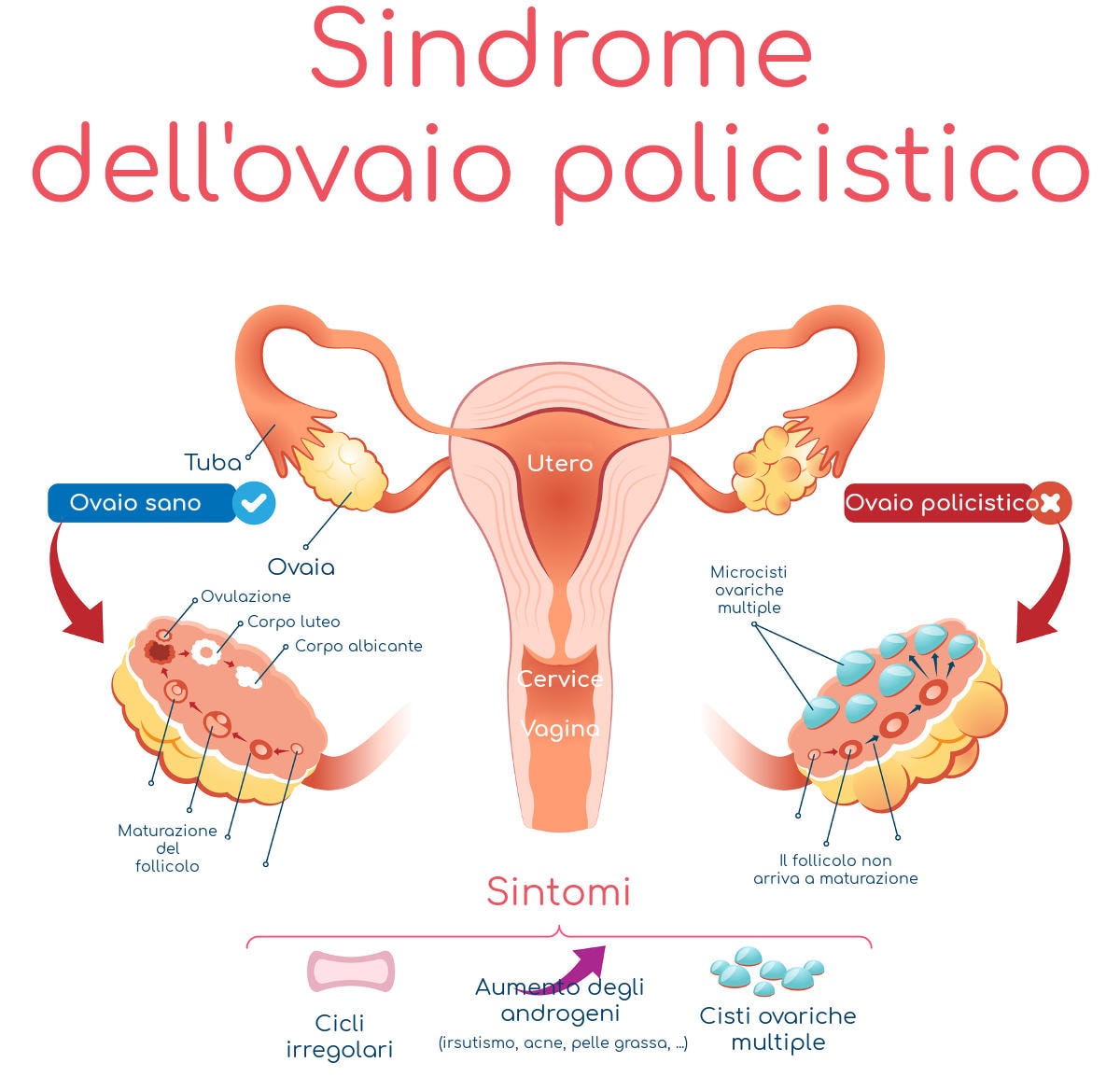 Ovaio policistico, infografica semplificata
