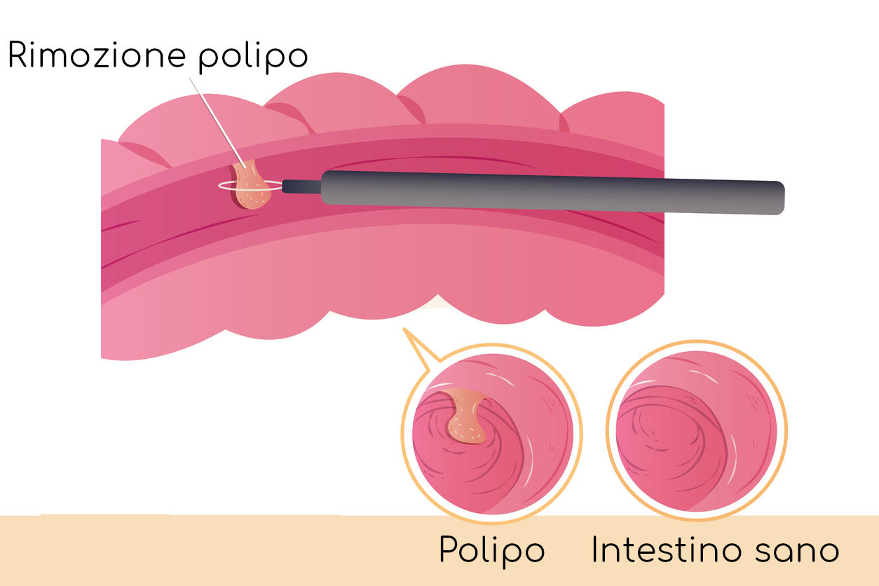 Disegno della rimozione di un polipo con il colonscopio 