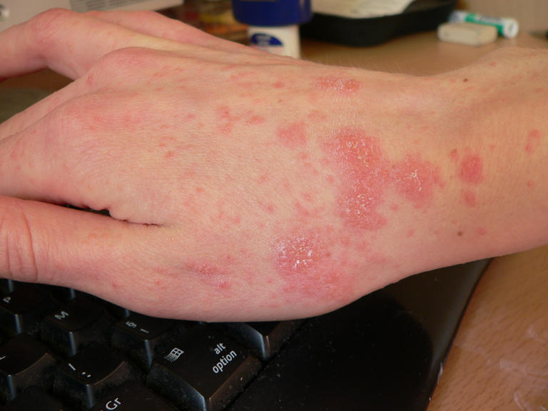 Foto dell'infezione da scabbia sulla mano