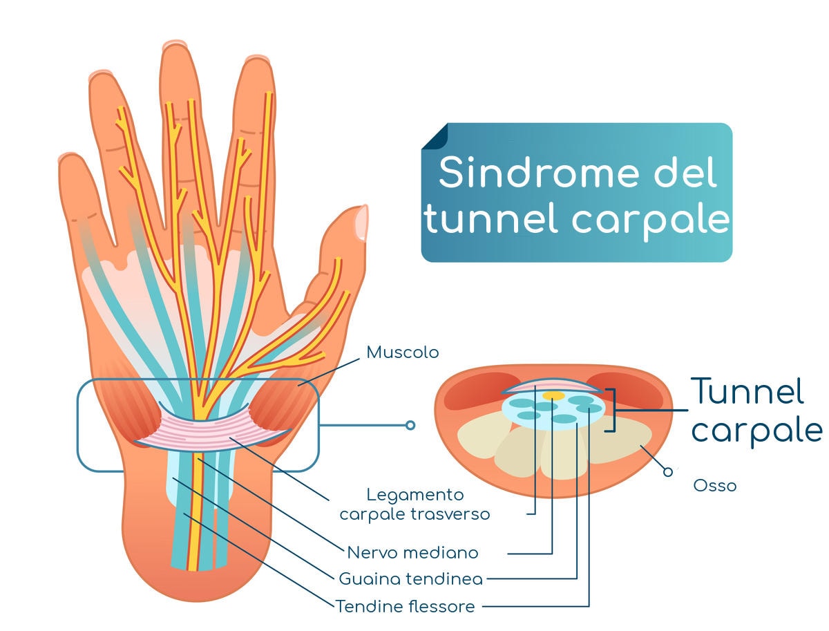 Semplificazione grafica dell'anatomia del tunnel carpale