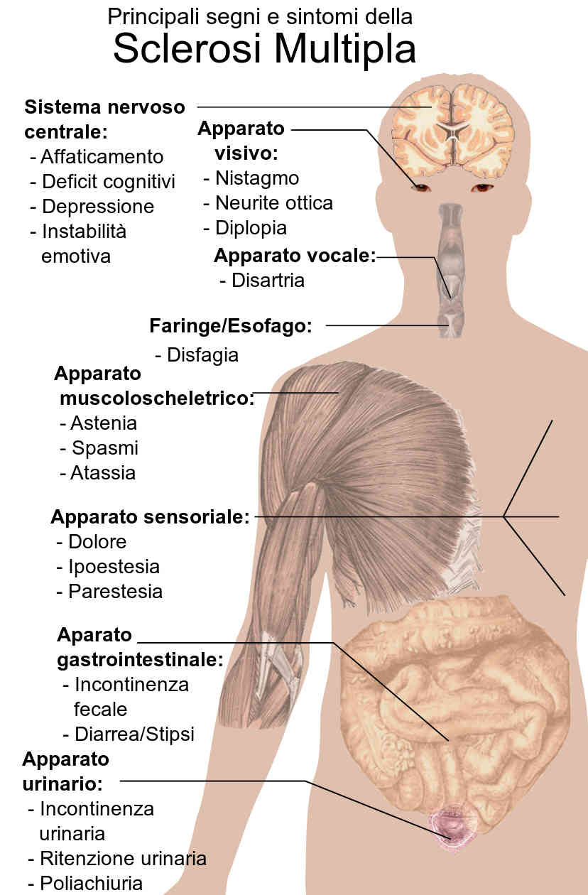Ricostruzione grafica dei principali segni e sintomi della sclerosi multipla