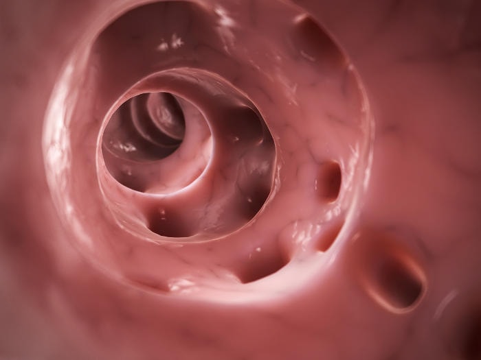 Diverticoli all'interno dell'intestino, ricostruzione grafica