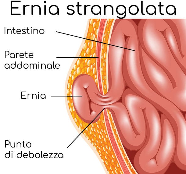 Ernia strangolata