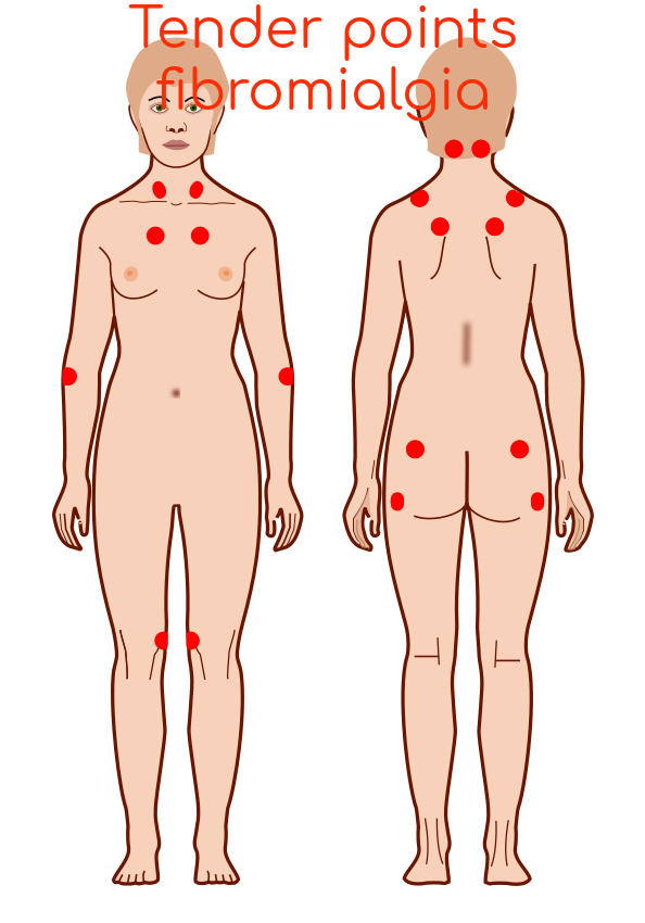 Schema dei tender points tipici della fibromialgia