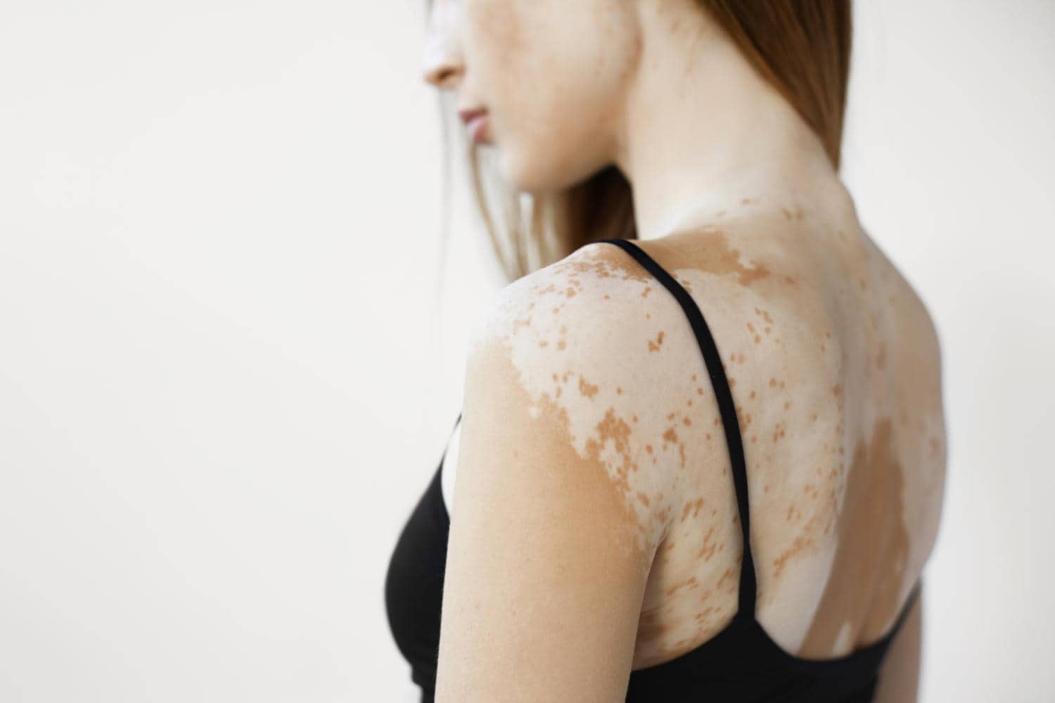 Schiena di una donna affetta da vitiligine