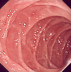 Immagine esemplificativa di quanto pu&ograve; osservare il medico durante l'esecuzione della gastroscopia