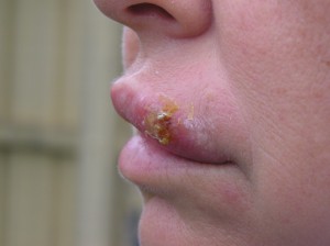 febbre-sul-labbro https://en.wikipedia.org/wiki/File:Cold_sore.jpg