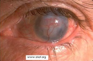herpes oculare, possibile conseguenza di herpes genitale