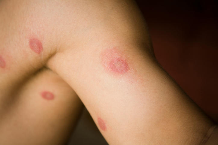 Fotografia di infezioni da tigna su un braccio; sono caratteristiche per la loro forma tondeggiante