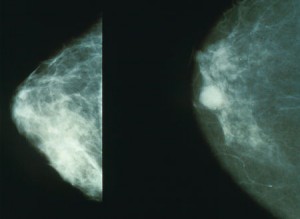 Mammogramma Mammogramma, nella figura di destra un tumore