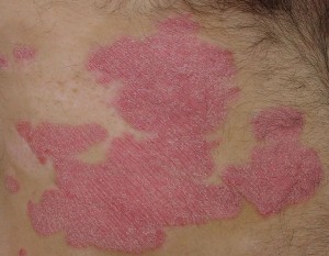 Placche psoriasi