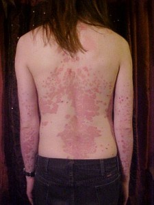 Psoriasi sulla schiena