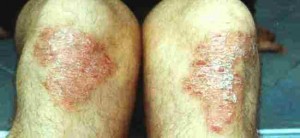 Psoriasi sulle ginocchia