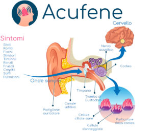Acufene dell’orecchio: cause, sintomi, rimedi e cura - The Wom Healthy
