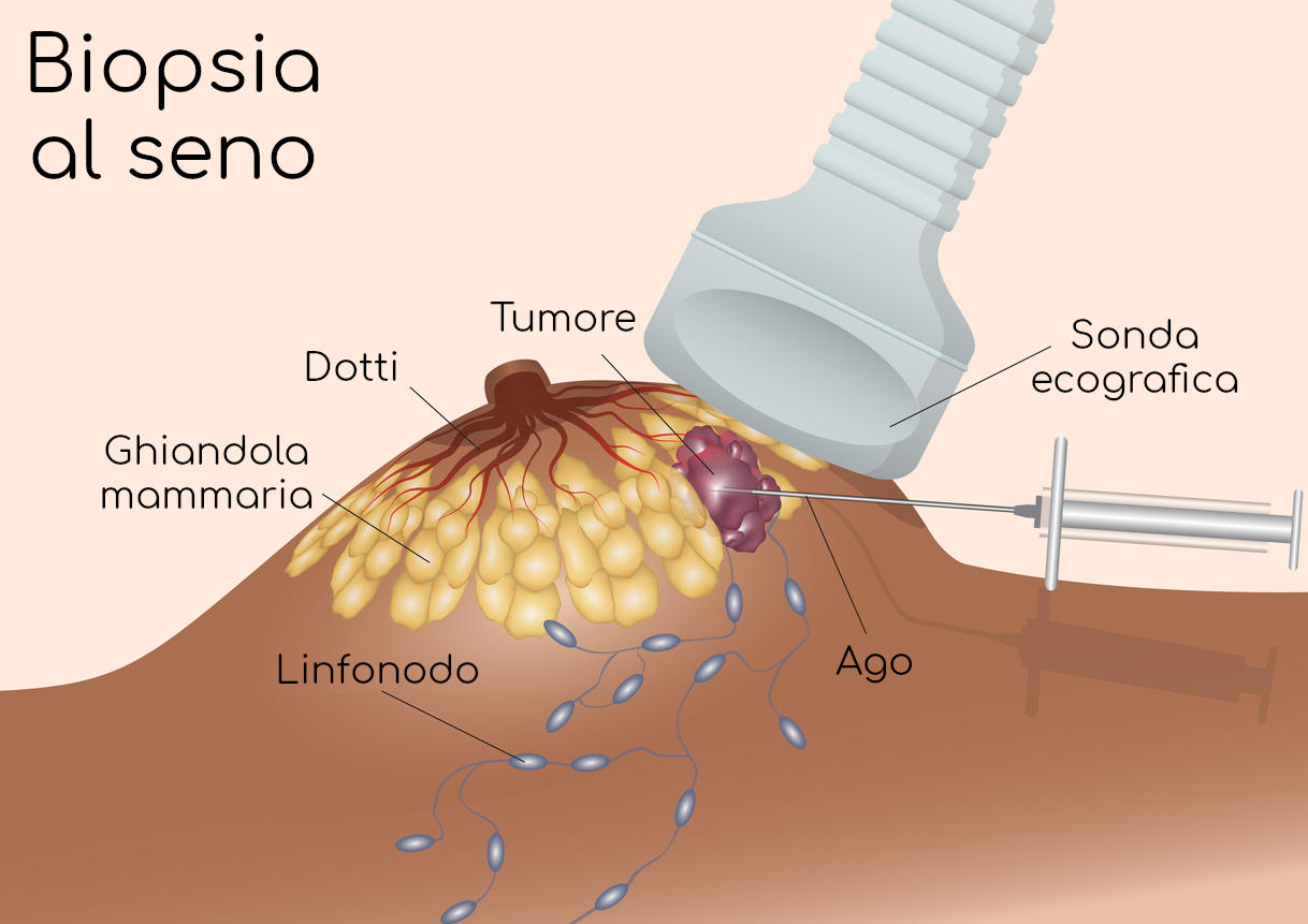 Schematizzazione della biopsia al seno