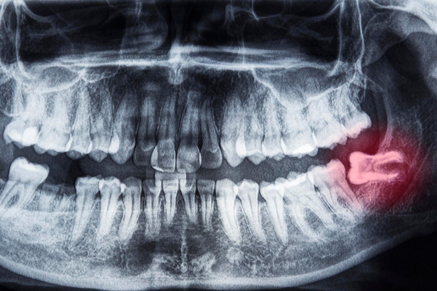 Dente del giudizio, radiografia