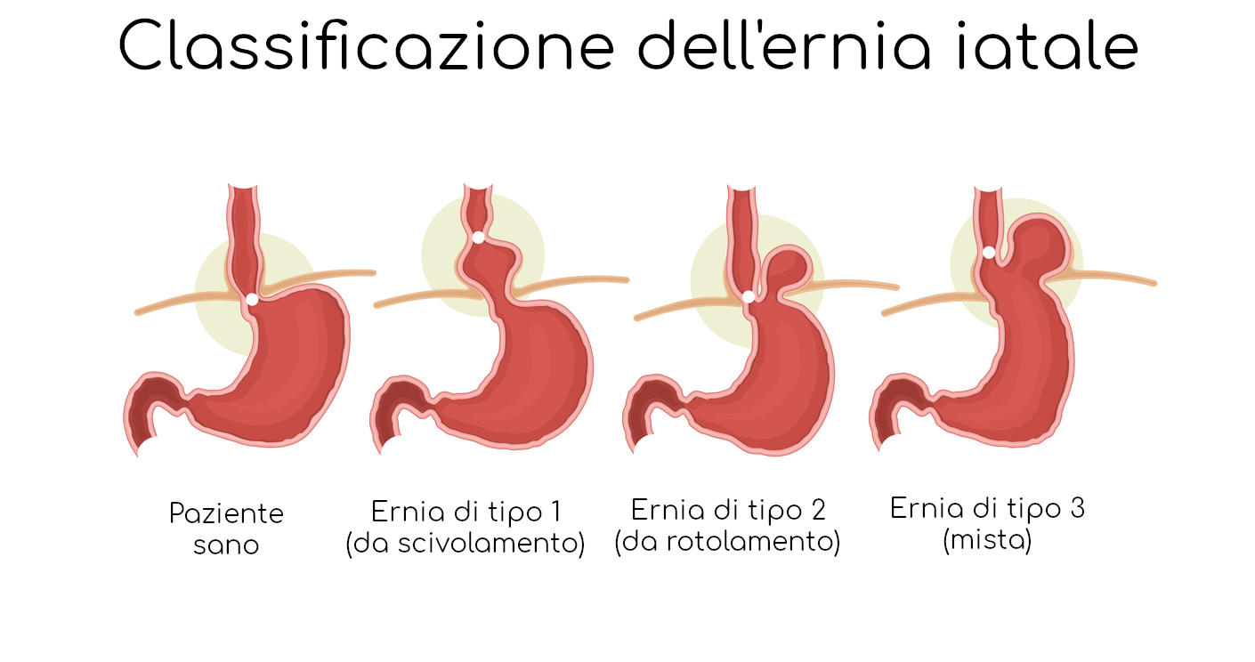 Classificazione dell'ernia iatale (scivolamento, rotolamento, mista)