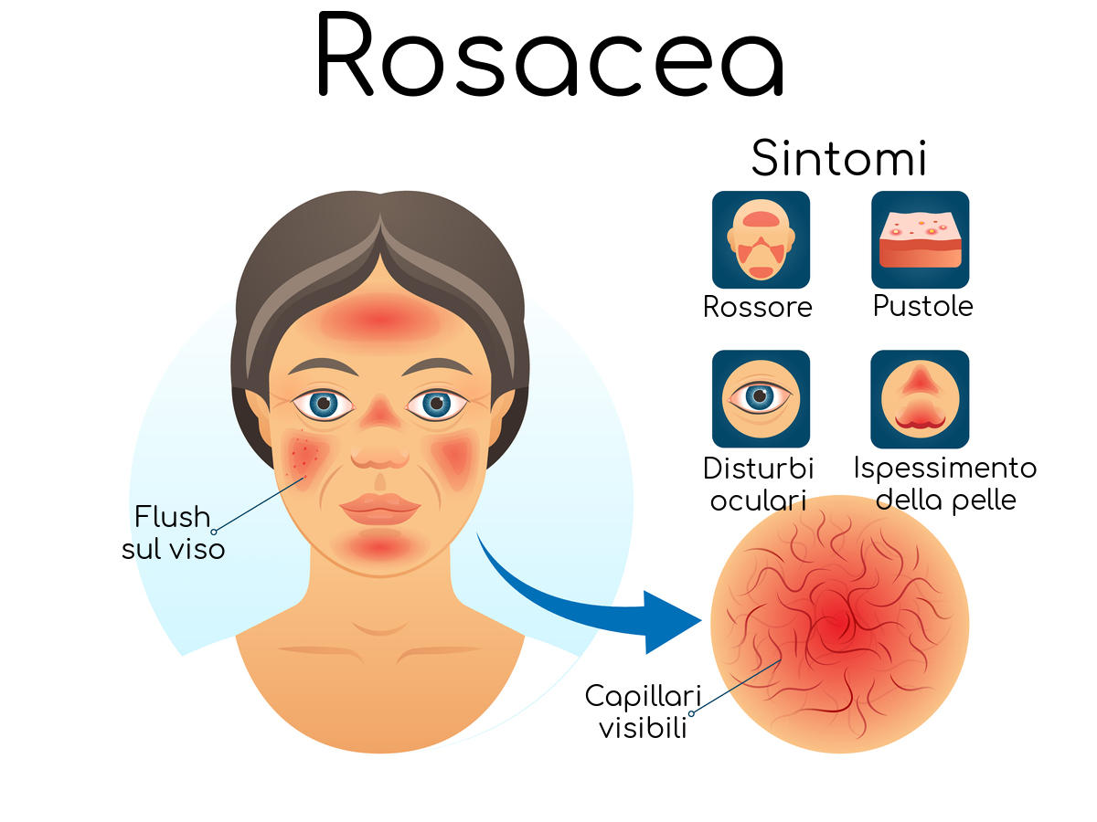 Infografica riassuntiva sulla rosacea