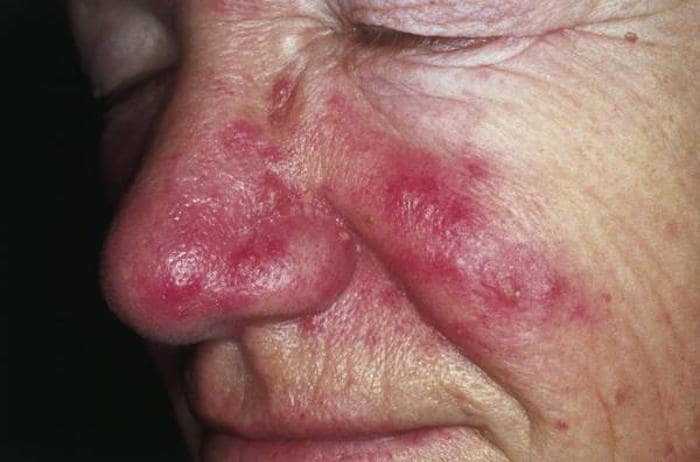 Particolare della rosacea sul viso