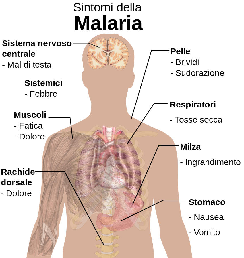 Schema riassuntivo con i principali sintomi della malaria