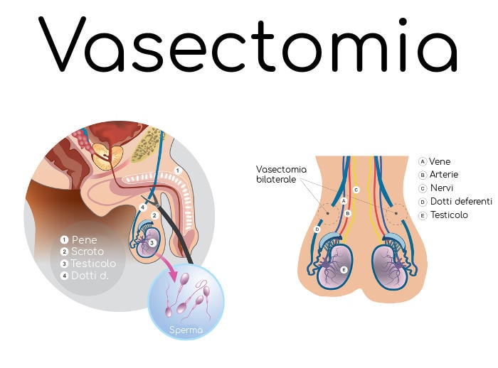 Rappresentazione grafica semplificata della vasectomia